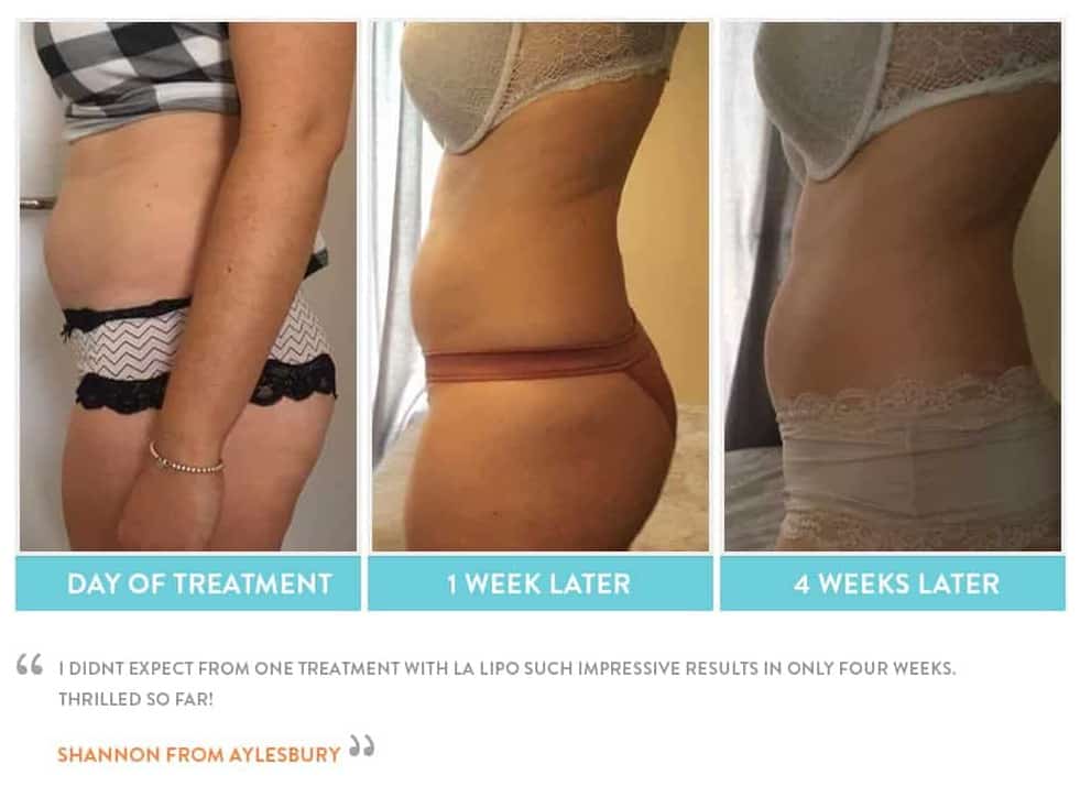 before, Cryolipolysis Ealing