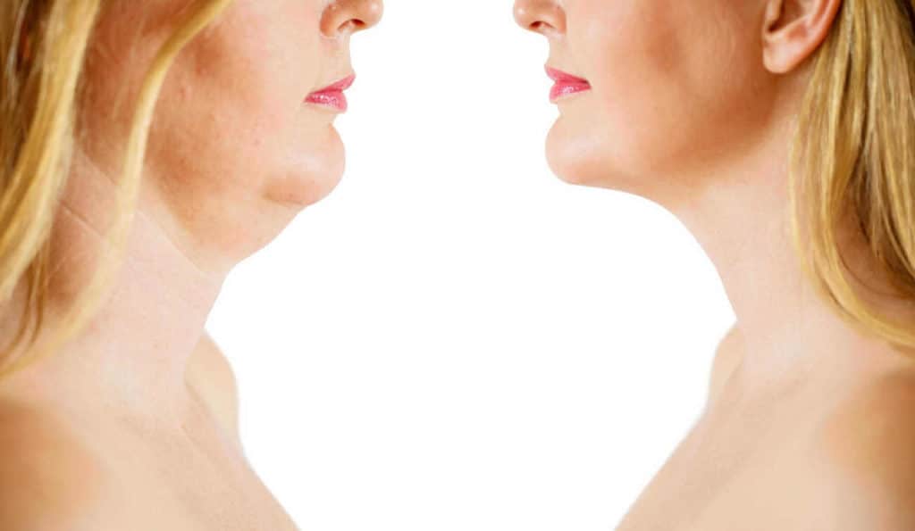 Double Chin treatment Ealing before and after results