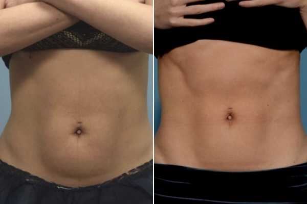 body sculpting FAQs Ealing
