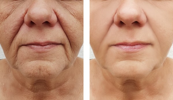 Learn more about Morpheus8 Treatment Ealing today!