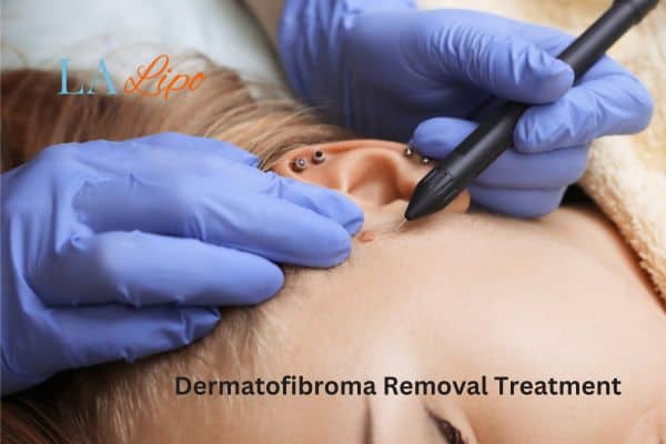 Dermatofibroma Removal Treatment Ealing