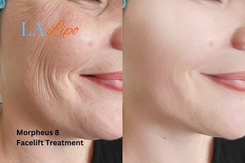 Morpheus8 Treatment Ealing for flawless skin! Call us today!