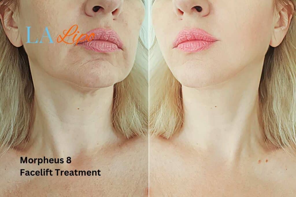 Turn back time with Morpheus8 Treatment Ealing