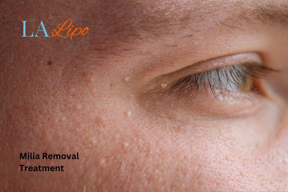 Cryopen Milia Removal: Is It the Easiest and Safest Option Ealing?