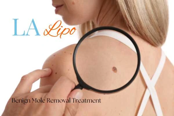 Woman having her inspection of blemish before mole removal Ealing