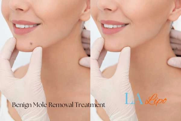 woman's before and after mole removal Ealing results