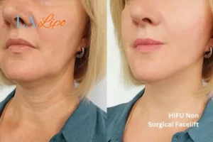hi-fu for wrinkles Ealing before and after results