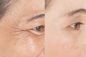 Before and after results of woman - HI-fu wrinkles reduction treatment Ealing