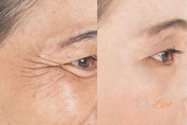 Before and after results of woman - HI-fu wrinkles reduction treatment Ealing
