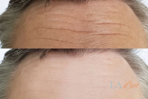 results of HIFU Ealing on mans forehead to help reduce lines and wrinkles