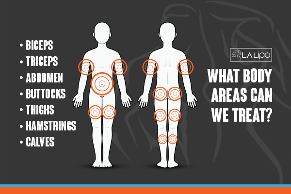 Graphic to show areas you can have LA-EMS Body Sculpting Ealing treatment.