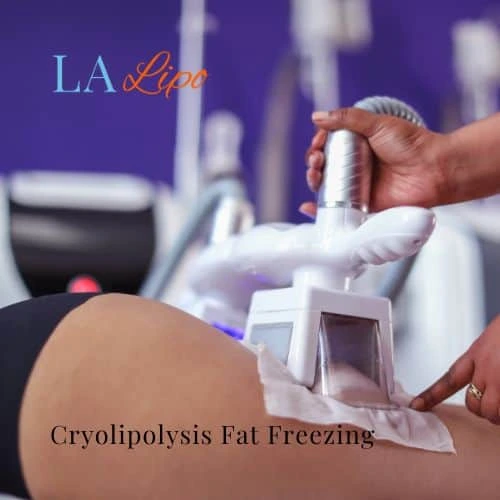 fat freezing - Cryolipolysis Ealing
