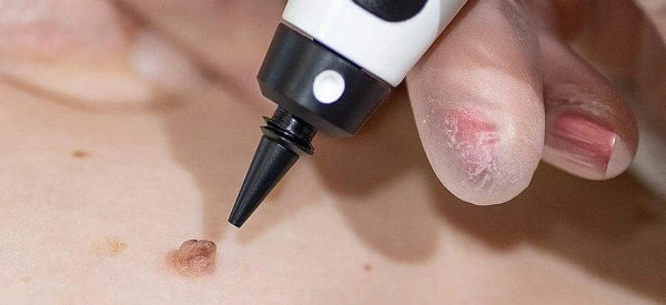 skin tag removal using cryopen Ealing