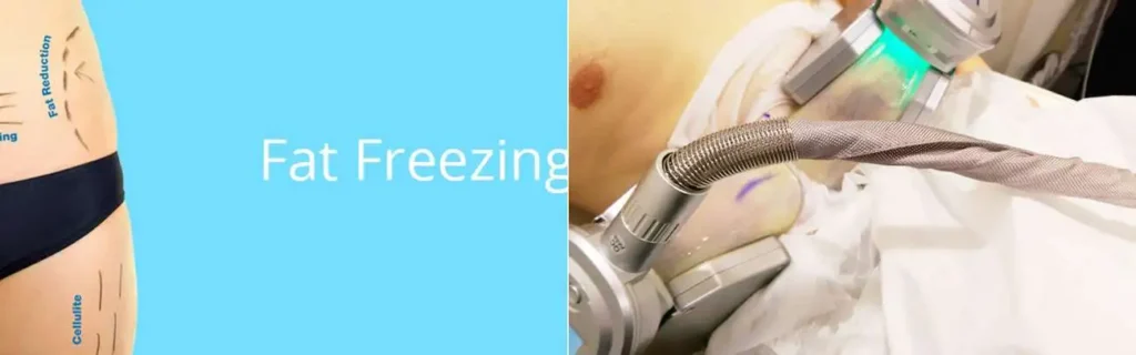 multi areas of a persons body having coolsculpting Ealing treatment