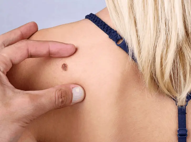 woman having mole removal Ealing consultation before treatment.