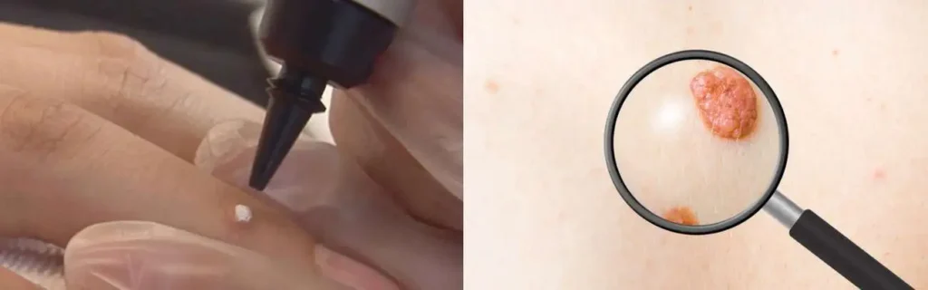 Cryopen for mole removal Ealing - speak to our team today!