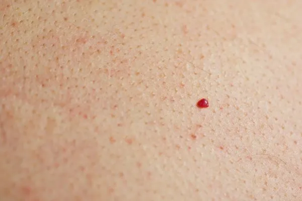close up of a cherry angioma Ealing