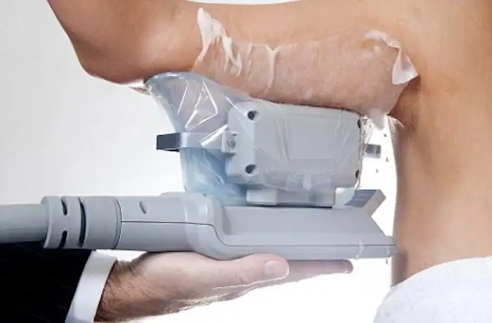 Picture of fat freezing Ealing on the upper arms.