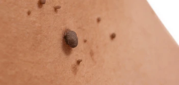 image of a skin tag Ealing