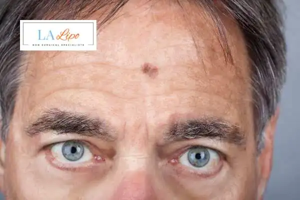 Solar Lentigo Removal Ealing image of man with mark on his forehead