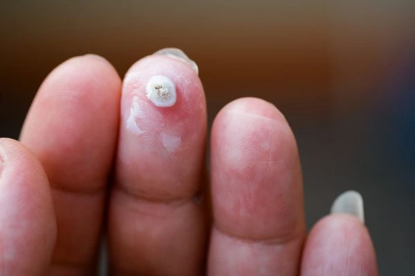 wart on person finger - cryotherapy to treat from LA LIPO Ealing