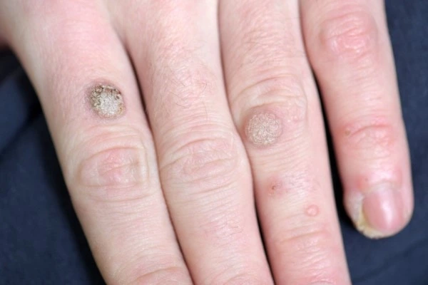 photo of warts on person hand - see wart removal Ealing from LA LIPO