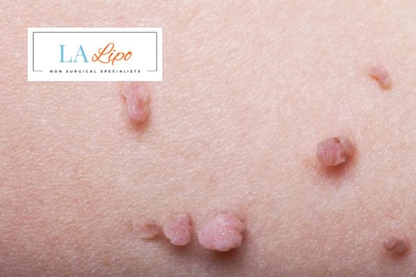 Does cryopen skin tag removal Ealing hurt? Find out now call our team today!