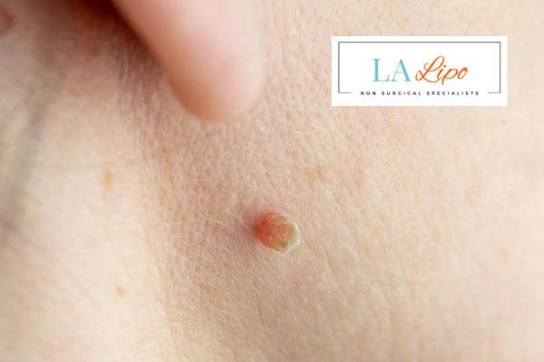 Book skin tag removal Ealing today speak to our team now!