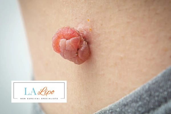 Interested in skin tag removal Ealing? Concerned about the pain? Find out more today!
