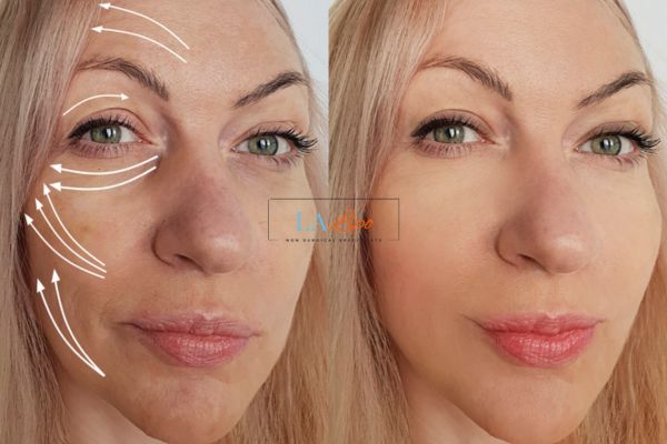 Morpheus 8 results Ealing face lift.