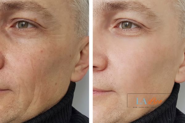 See the amazing results of Morpheus8 Treatment Ealing!