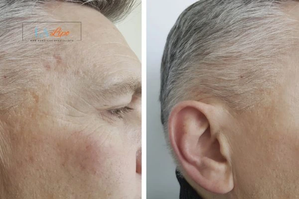 Mens Before & After Morpheus 8 Results Ealing