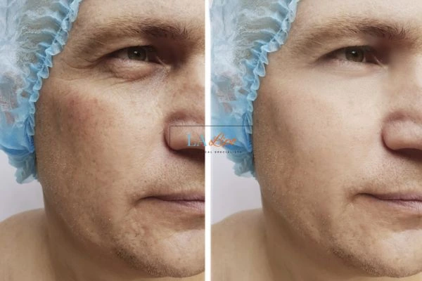 Before and after Morpheus 8 Results Ealing