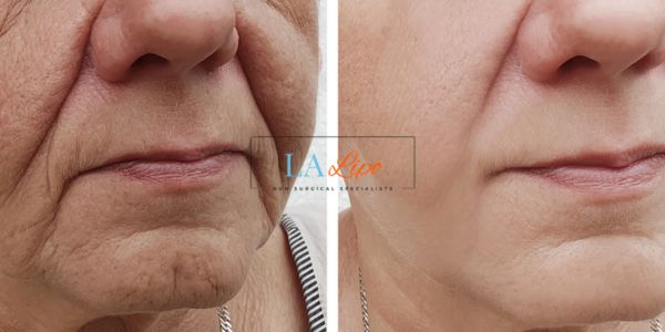 Older lady deeper wrinkle reduction - LA LIPO Morpheus 8 Results Ealing