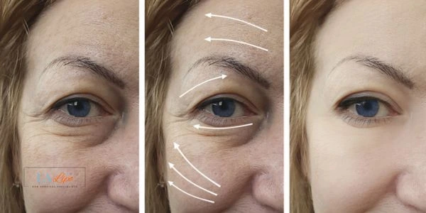 Amazing eye lift Morpheus 8 results Ealing