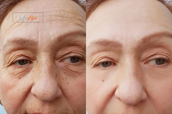 The powerful benefits of Morpheus8 Treatment Ealing - Call Our team today!