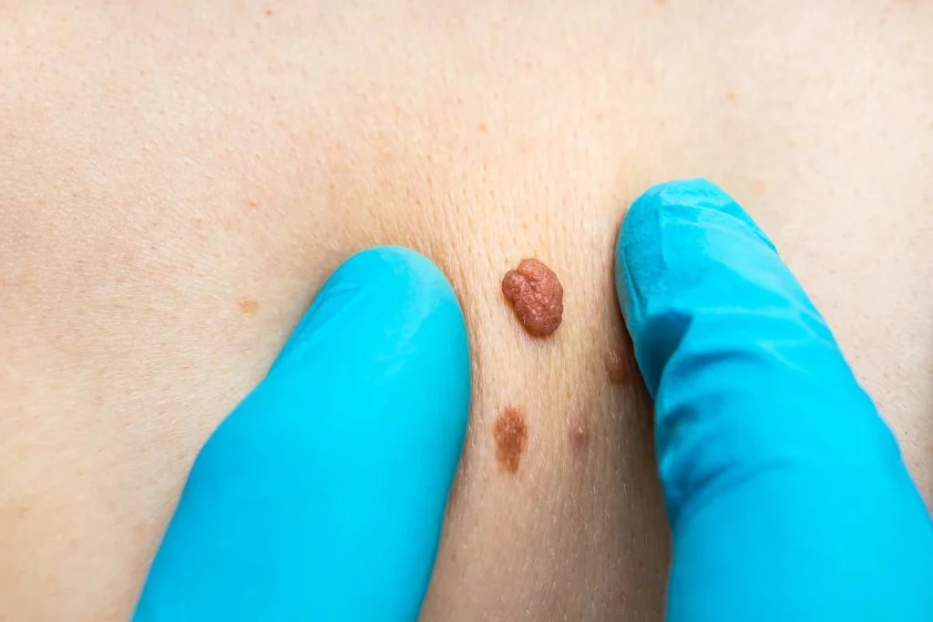 LA LIPO Cryopen Lesion Removal Prices Ealing