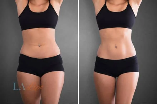 before and after results of non-surgical treatment to help a woman's body image and mental health Ealing