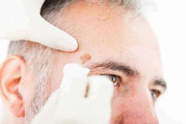 Age spots and elderly people Ealing what is the link?