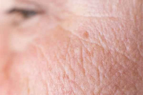 close up picture of a woman's face showing an age spot Ealing