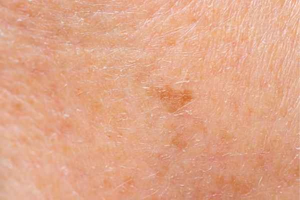 close up picture of age spots Ealing