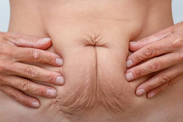 Image of a woman's stomach with loose skin - example of skin tightening Ealing options