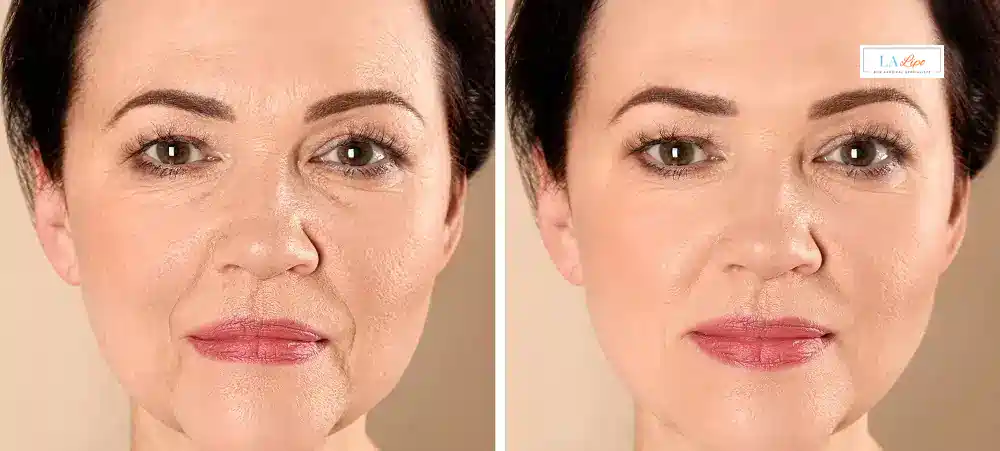 How Long Does It Take to See Results and How Long Do They Last Ealing?