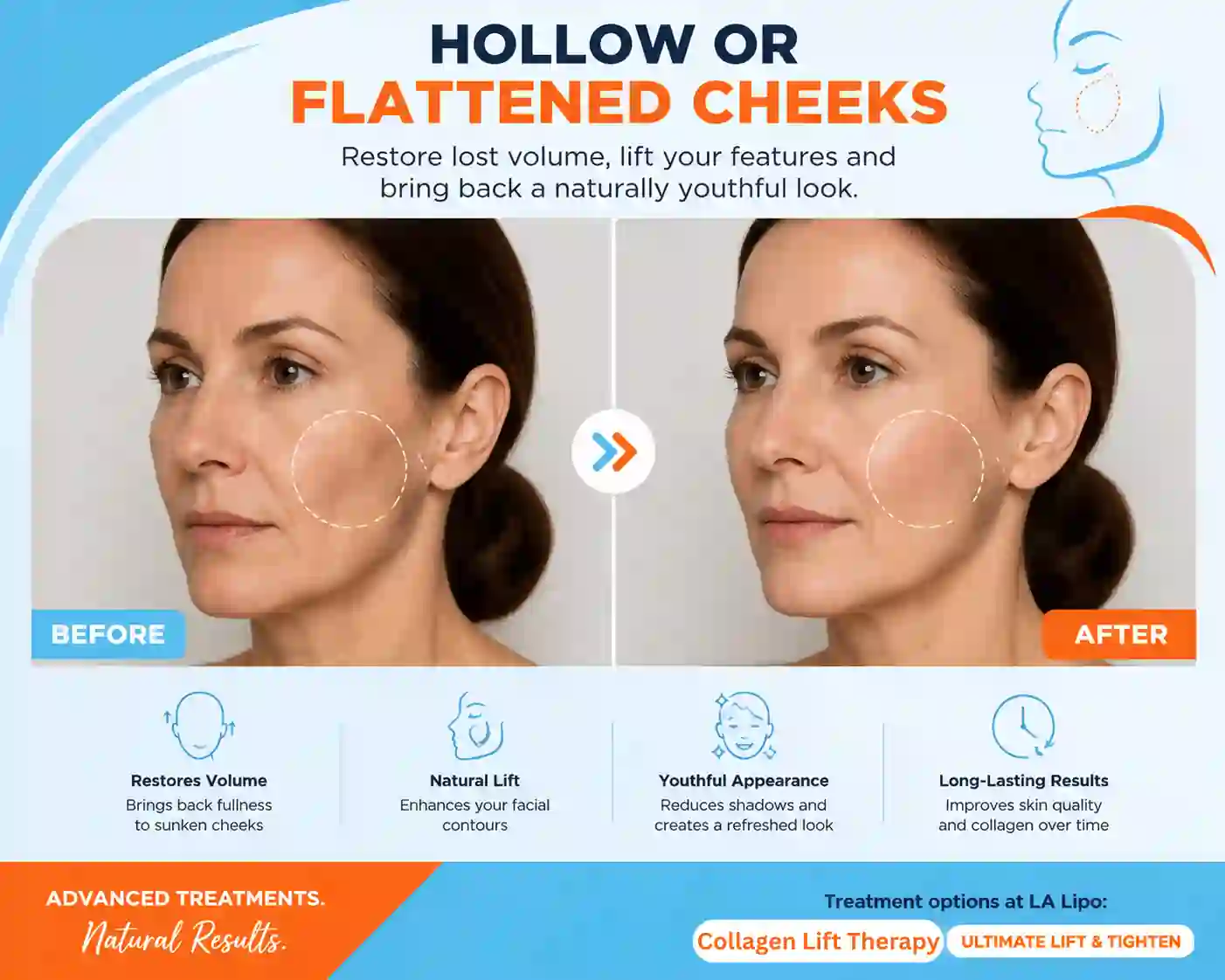Sign #4: Hollow or Flattened Cheeks Ealing